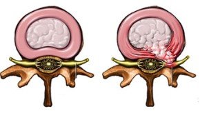 herniated disc